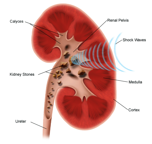 treating-nephrolithiasis-an-overview-of-medical-treatments-their